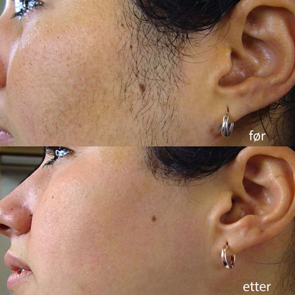 SilkX IPL Laser - Hår fjerningsapparat