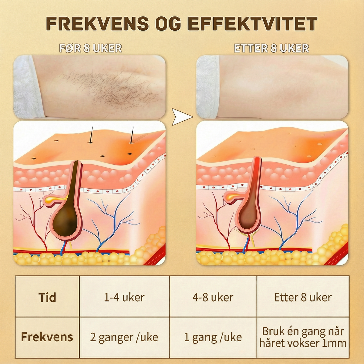 SilkX IPL Laser - Hår fjerningsapparat