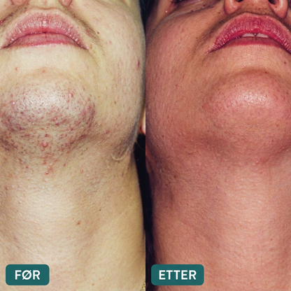 SilkX IPL Laser - Hår fjerningsapparat