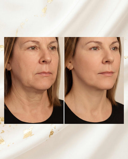 "KDiamondSkin Luxylift for selvpleie™ - KDiamondSkin