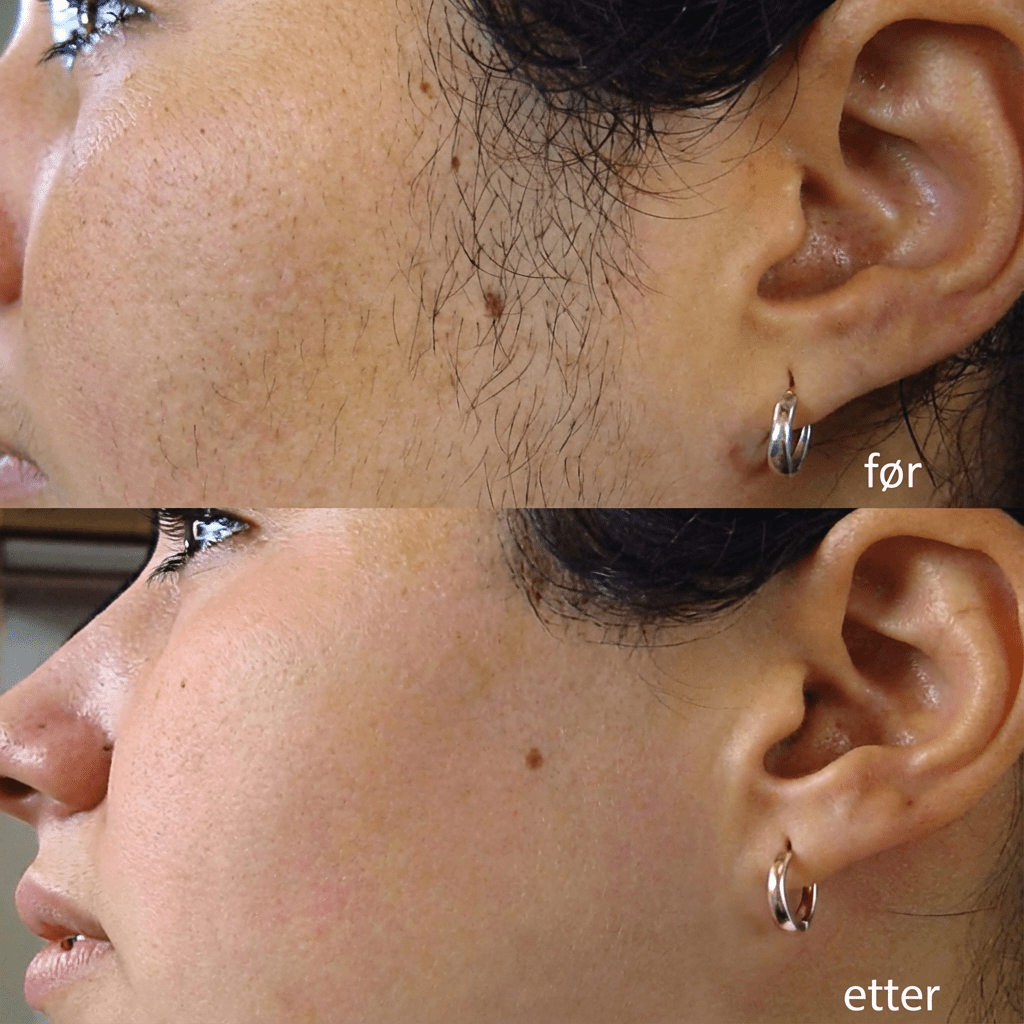 SilkX IPL Laser - Hår fjerningsapparat - KDiamondSkin
